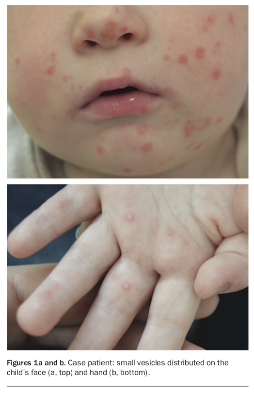 A 6monthold boy with a vesicular rash Medicine Today